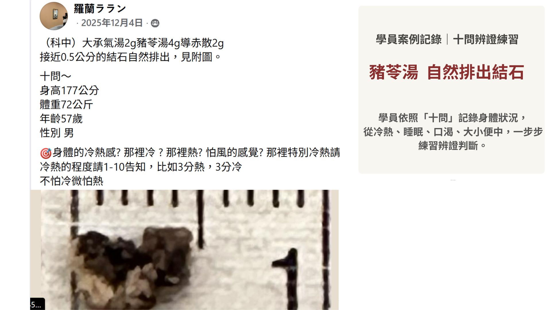豬苓湯,自然排出結石|經方百日訓練營學員成功案例01