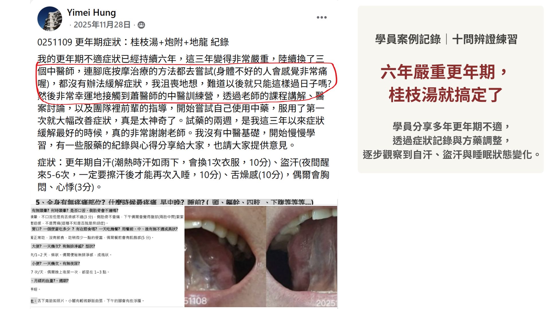 六年嚴重更年期,桂枝湯就搞定了|經方百日訓練營學員成功案例03