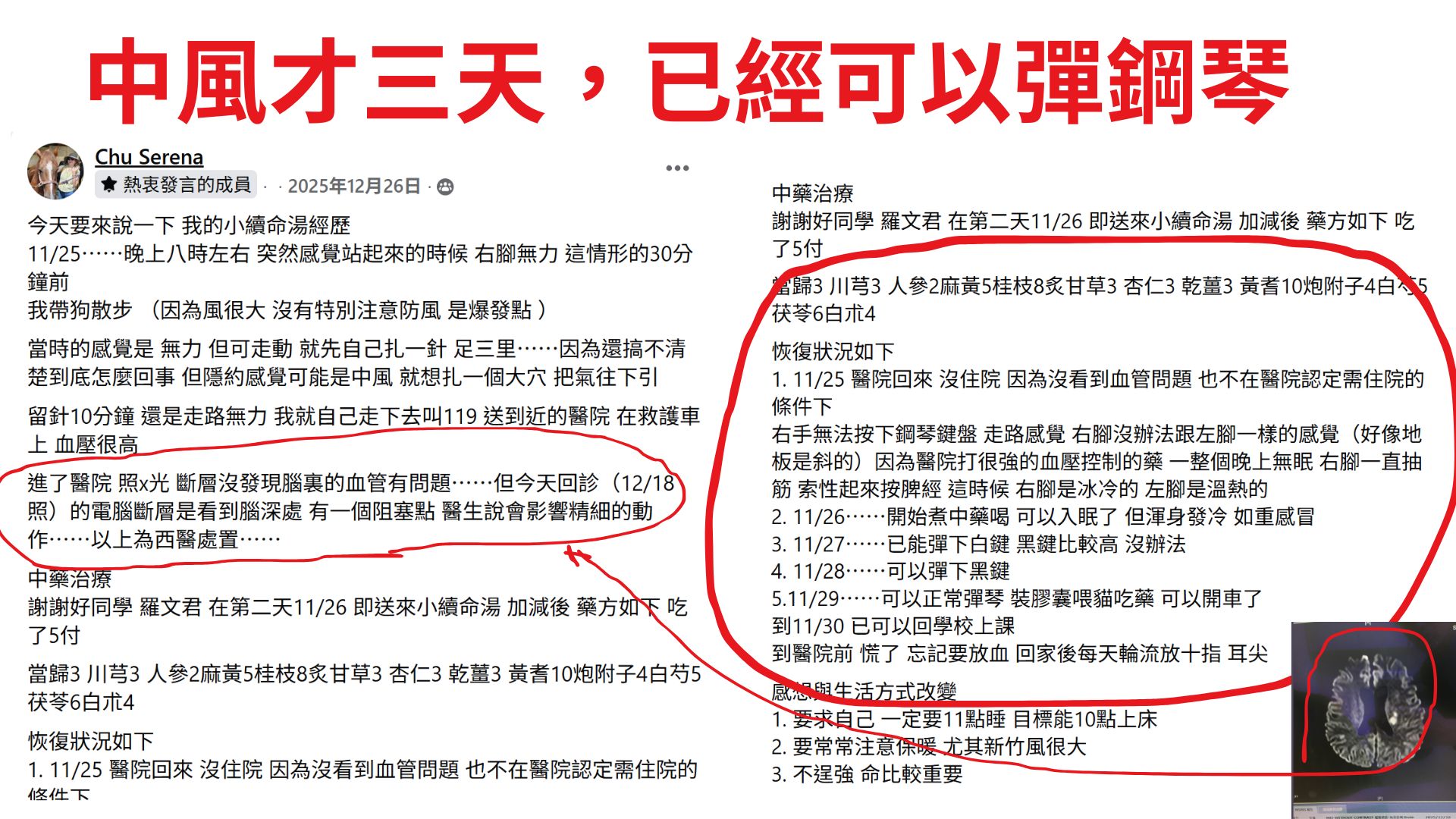 中風才三天,已經可以彈鋼琴|經方百日訓練營學員成功案例07