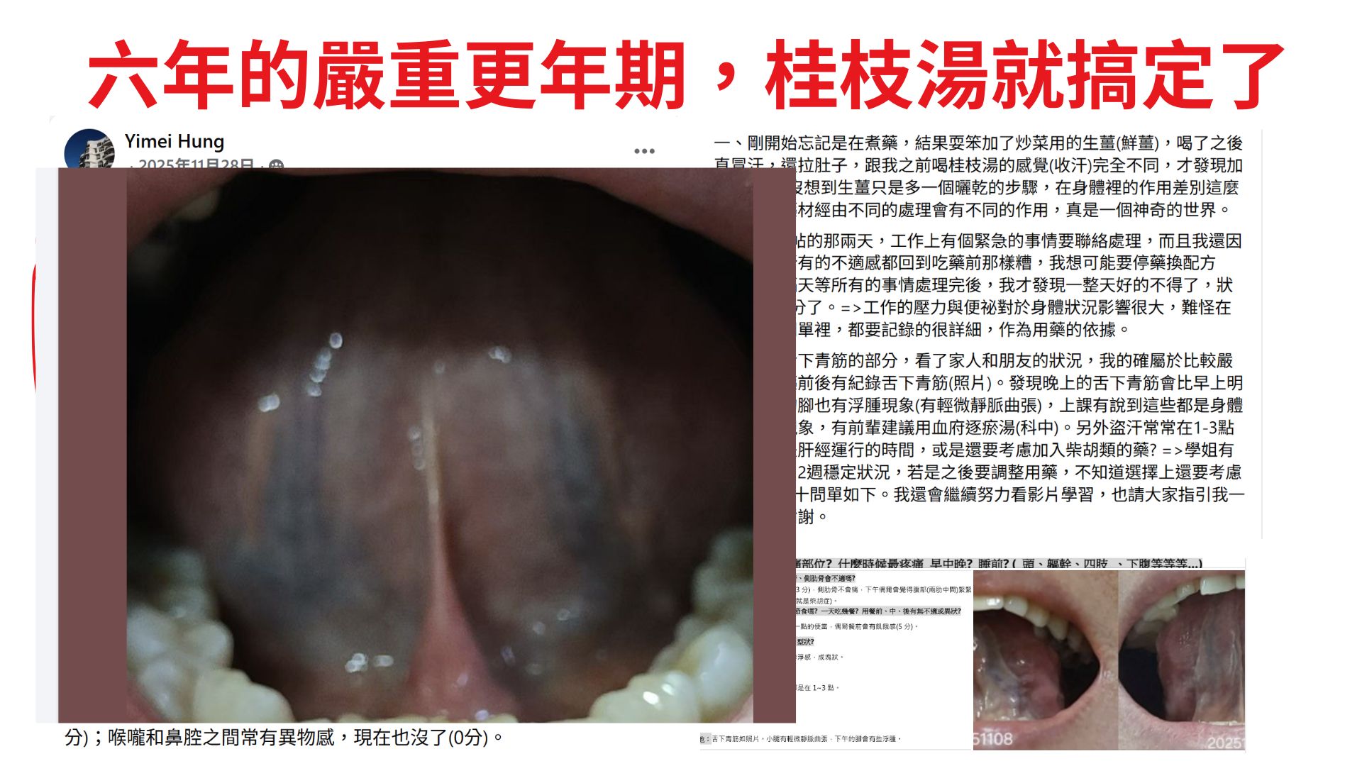 六年的嚴重更年期,桂枝湯就搞定了|經方百日訓練營學員成功案例08